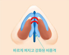비중격과 코 내부 강화
