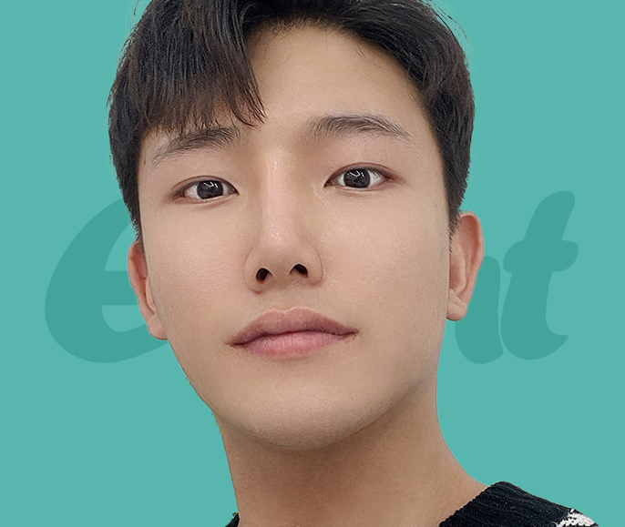 ★나나 남자코성형★