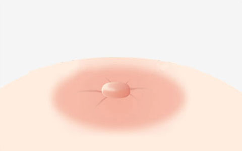 함몰유두