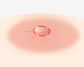 1~2mm 유두주변 절개