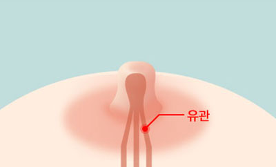 유관을 보존하여 수술 모유수유 영향을 미치지 않음