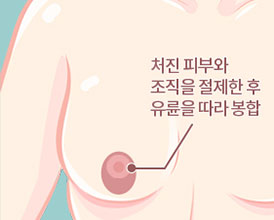 유선조직 절제 봉합