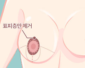 처짐 정도가 경미한 유방