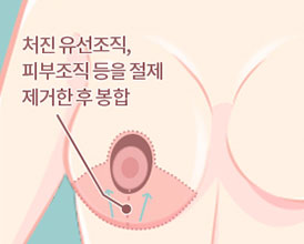 유두를 당겨 올려줌