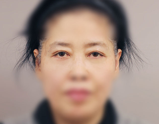 눈 after 이미지