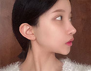 안면윤곽 before after