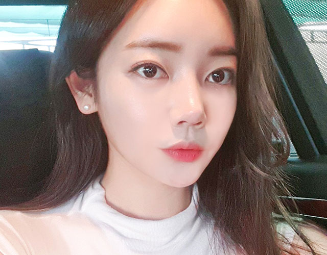 안면윤곽 after 이미지