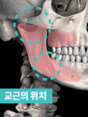 제대로 된 위치의 교근 고정으로 부작용 발생을 막는 광대축소술 이미지