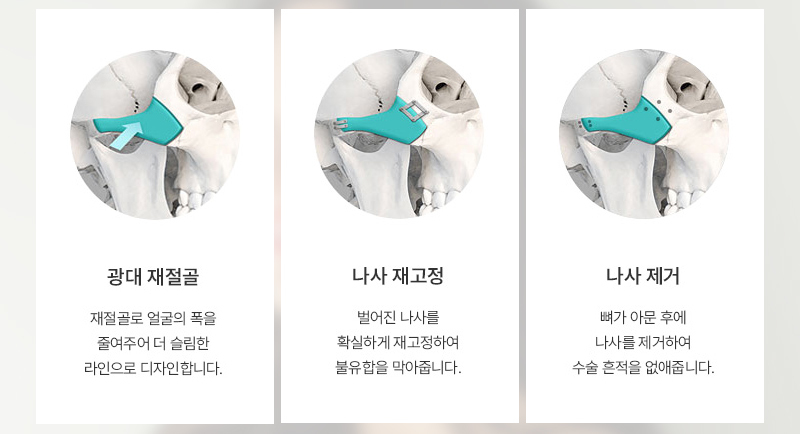 개인 얼굴 구조에 맞춘 광대 재수술 방법 안내
