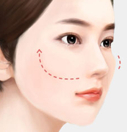 나나성형외과 안면윤곽 재수술 필요 사례 이미지, 1차 윤곽수술 후 45도 광대가 두드러져 윤곽 라인 재교정이 필요한 경우