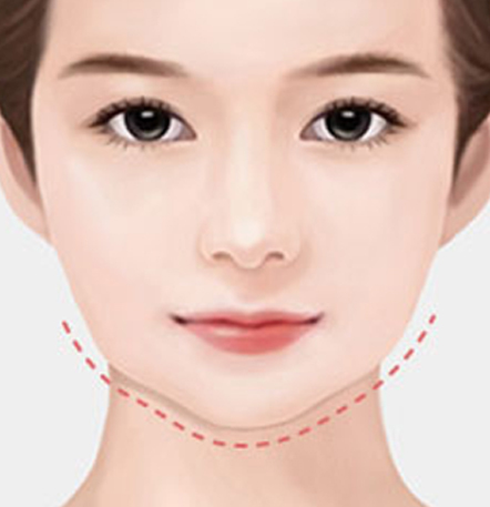 나나성형외과 안면윤곽 재수술 필요 사례 이미지, 1차 윤곽수술 후 처짐이 발생해 라인 정리와 재교정을 고려하는 경우