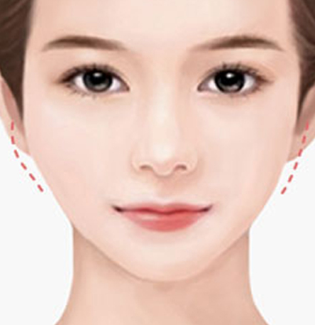 나나성형외과 안면윤곽 재수술 필요 사례 이미지, 1차 윤곽수술 후 좌우 비대칭이 남아 균형 교정을 위해 재수술을 고려하는 경우