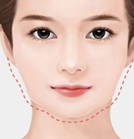 나나성형외과 안면윤곽 재수술 필요 사례 이미지, 1차 윤곽수술 후 얼굴 윤곽 라인이 고르지 않고 매끄럽지 않아 재교정이 필요한 경우