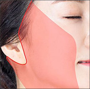귀의 경계를 따라 절개