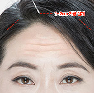 헤어라인 안쪽 절개
