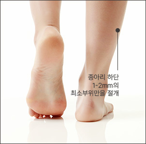 미세절개로 흉터걱정 NO!