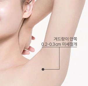 최소절개, 나나 지방흡입