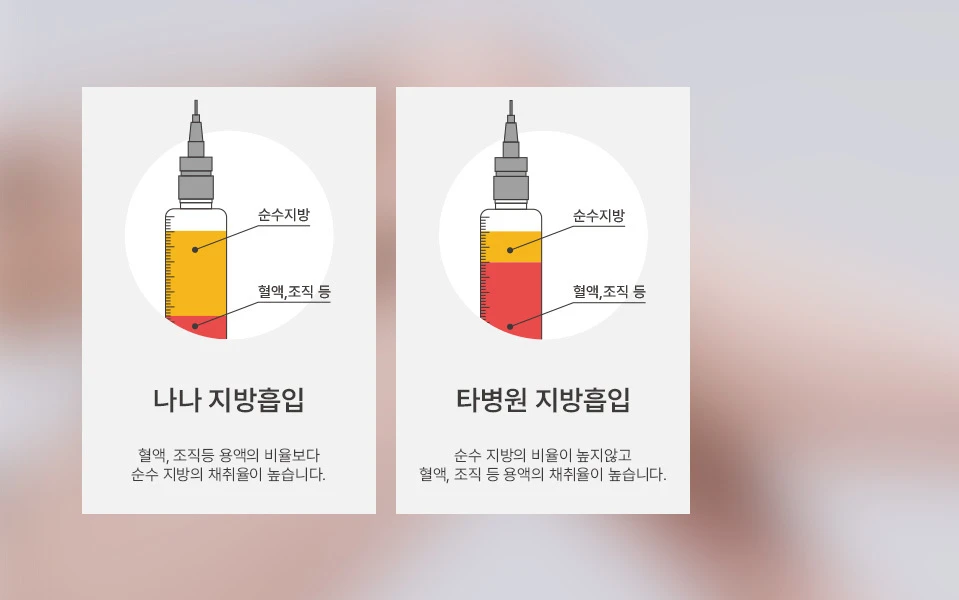 나나성형외과의 엉덩이지방흡입