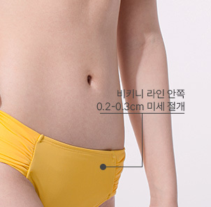 최소절개, 나나 지방흡입