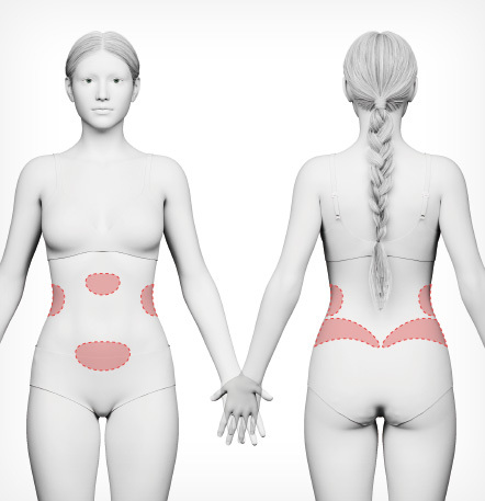 복부 포인트 지방흡입