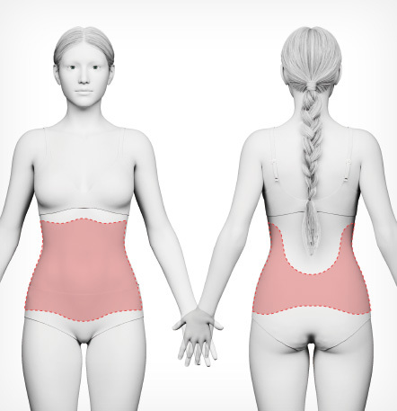복부 대용량 지방흡입