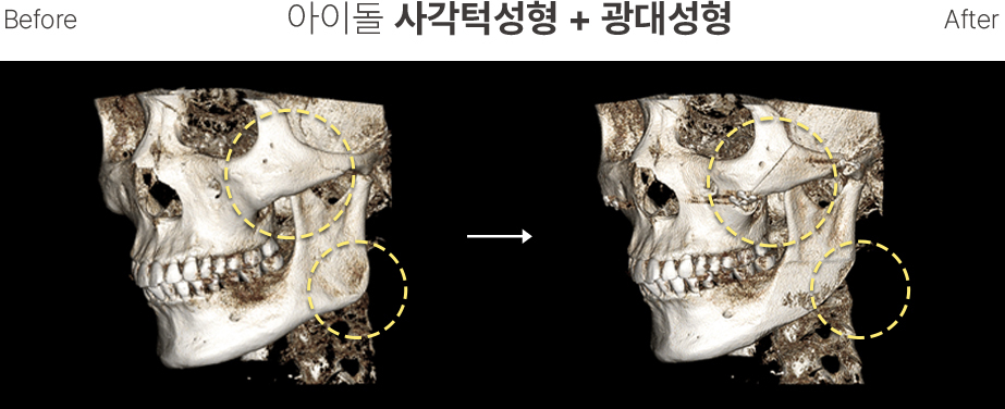 남자윤곽 CT1