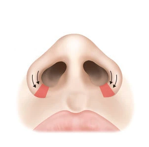디자인에 따라 피부 절개