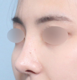 맞춤형 코성형을 진행한 매부리 코 유형 고객의 수술 후 45도 부분 이미지