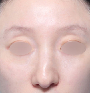맞춤형 코성형을 진행한 휜코 유형 고객의 수술 전 정면 부분 이미지