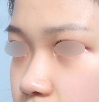 맞춤형 코성형을 진행한 복코 유형 고객의 수술 전 45도 부분 이미지