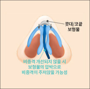 비중격 개선으로 부작용 방지