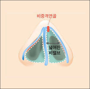 비밸브 수술