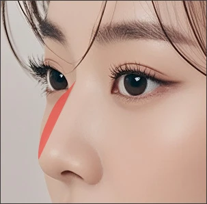 매부리의 정도에 따라 교정