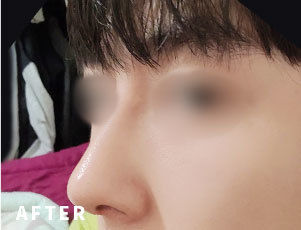 성형 후 이미지