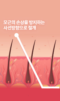 모근을 살리는 절개