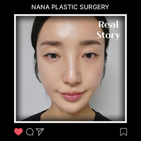 안면윤곽 3종 수술 6개월 후